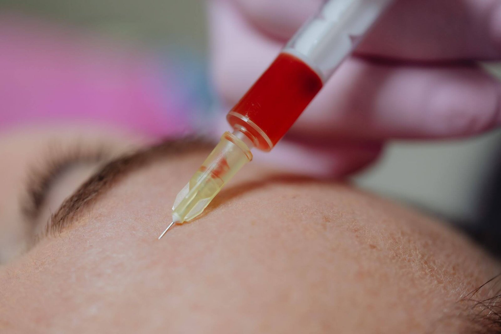 Microneedling
